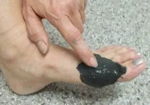 Bone egy láb a hüvelykujj kezelésére népi jogorvoslat (kezelés) Bone egy láb a hüvelykujj kezelésére emberek jogorvoslatok