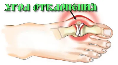 Csontok nagylábujj - kezelés, kezelés otthon
