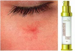 Krém Tiande (TianDe) rosacea az arc szerkezete, tulajdonságai, valós (Tiande) Krém Tiande (Tiande) rosacea az arc szerkezete, tulajdonságai, valós