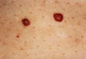 Red anyajegy okoz, függetlenül attól, hogy veszélyes, kezelési és eltávolítási gyermekek és felnőttek, az ABC (mol) Ők vörös anyajegy okait, veszélyes, kezelési és eltávolítási gyermekek és felnőttek, ABC