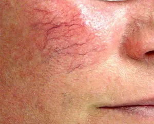 Krém Tiande (TianDe) rosacea az arc szerkezete, tulajdonságai, valós (Tiande krém) Krém Tiande (Tiande) rosacea az arc szerkezete, tulajdonságai, valós