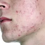 Rosacea kezelés otthon, fotók, vélemények, okok, eltávolítása