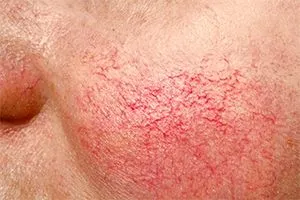 Rosacea kezelés otthon, fotók, vélemények, okok, eltávolítása