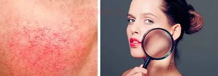 Rosacea az arc - kezelés otthon