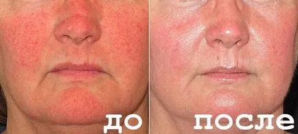 Rosacea kezelés otthon, fotók, vélemények, okok, eltávolítása