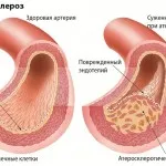 A kezelés népi jogorvoslati alsó végtag arterioszklerózis (kezelés) A kezelés népi jogorvoslati alsó végtag érelmeszesedés