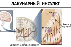Lacunaris infarktus agyi tünetek, kezelés és következményei (lacunaris) Hézagos infarktus agyi tünetek, kezelés és következményei