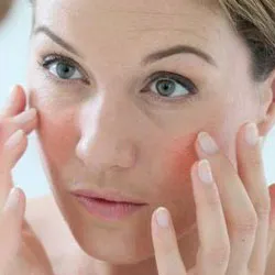 rosacea kezelés otthon népi jogorvoslati (belföldi) rosacea otthoni kezelés népi jogorvoslati