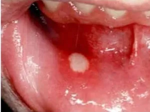 Cure stomatitis