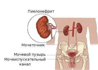 Drug Treatment pyelonephritis alapvető módszerek (húgyúti fertőzések) Drug Treatment pyelonephritis alapvető módszerek