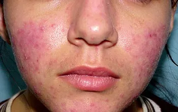 Rosacea kezelés népi jogorvoslati otthon (home) Rosacea kezelés népi jogorvoslati otthon