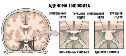 microadenomas agyalapi modern kezelés és a hagyományos orvoslás (gyógyszert) Hipofízis microadenomas modern és a hagyományos orvoslás