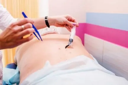 endometritis kezelése népi jogorvoslat