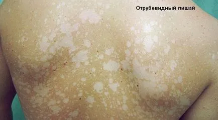 Pityriasis versicolor medicamental kezelésére és népi jogorvoslati