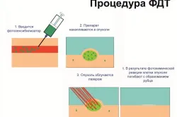 Sugárkezelés az onkológiában, típusai és következményei (videó) (terápia) Sugárkezelés az onkológiában, típusai és következményei (videó)