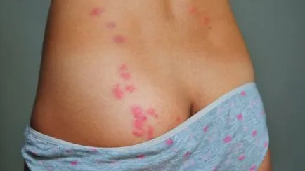 Hogyan működik a poloska harapás