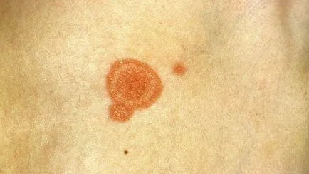 Kenőcs a herpes zoster, mint kenet, és az aciklovir tabletták (kenet) Kenőcs herpes zoster mint kenet, aciklovir és tabletták
