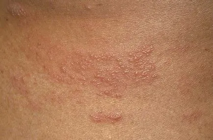 Kenőcs a herpes zoster, mint kenet, és az aciklovir tabletták (stripping) Kenőcs herpes zoster mint kenet, aciklovir és tabletták