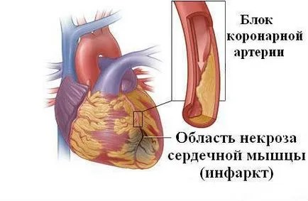 Szívizom és patológiai változások abban, markerek kár