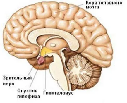 Microadenoma agyalapi okoz, tünetei és kezelések
