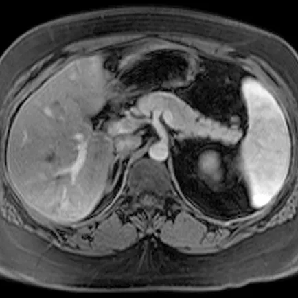 MRI a hasnyálmirigy, amely megmutatja, hogyan lehet a (hasnyálmirigy) MRI a hasnyálmirigy, amely megmutatja, hogyan lehet