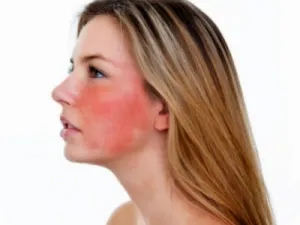 Népi rosacea kezelésére
