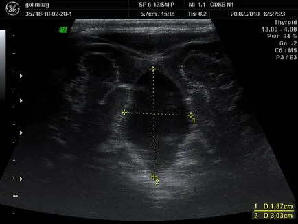 agy neurosonography újszülöttek (grudnichka), mi ez, ha igen, milyen korú