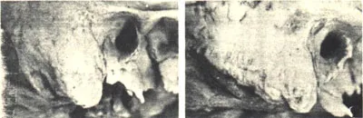 Mastoid régió - az orvostudomány