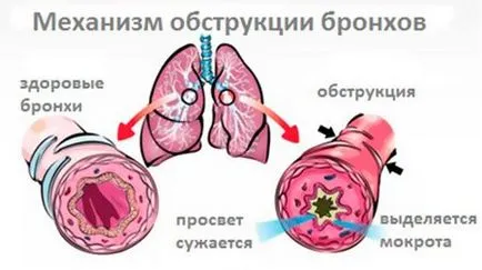 Obstruktív bronchitis gyermekeknél népi jogorvoslat, gyógyszerek