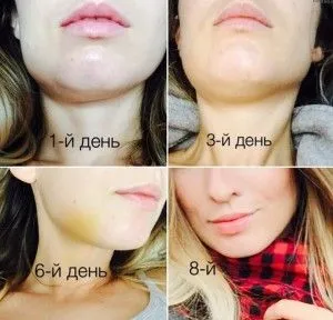 Duzzadt arc után fogat, mit kell tenni, hogyan kell eltávolítani duzzanat