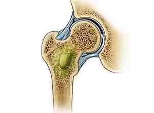 Osteomyelitis nemzeti bánásmód - betegségek, csontok és ízületek - Kiadó - a hagyományos gyógyszerek (kezelés) Osteomyelitis nemzeti bánásmód - betegségek, csontok és ízületek - Kiadó - a hagyományos gyógyszerek