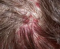 Chromophytosis otthoni kezelés ranotsvetnogo megfosztva népi jogorvoslati (pityriasis) Chromophytosis otthoni kezelés ranotsvetnogo megfosztva népi jogorvoslati