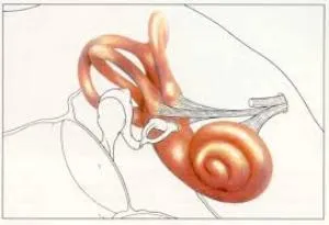 Otosclerosis tünetek és a kezelés a fül (fül otosclerosis) Otosclerosis tünetek és a kezelés a fül