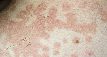 Chromophytosis otthoni kezelés ranotsvetnogo megfosztva népi jogorvoslati (övsömör) Chromophytosis otthoni kezelés ranotsvetnogo megfosztva népi jogorvoslati