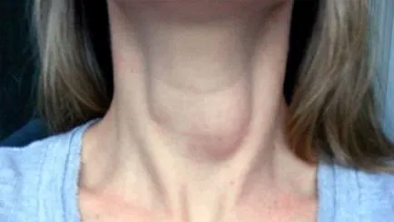Gégeoedema tünetek és a kezelés (tünetek) Gégeoedema tünetei és kezelése
