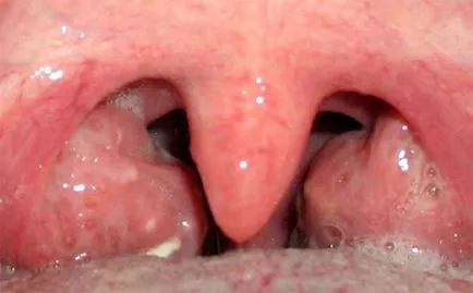 Gégeoedema tünetek és a kezelés (a gége a következménye) Gégeoedema tünetei és kezelése