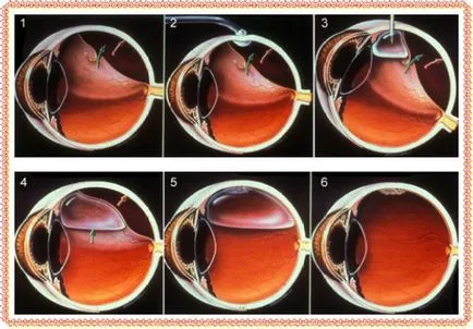 Leválása a retina okai és a jobb kezelési (szem) retinaleválás okai és jobb kezelési