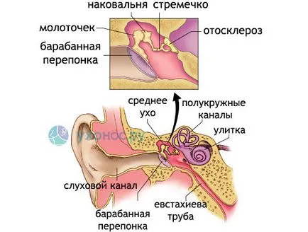 Otosclerosis tünetek, kezelés, üzemeltetés (kezelés) Az otosclerosis tünetek, kezelés, műtét