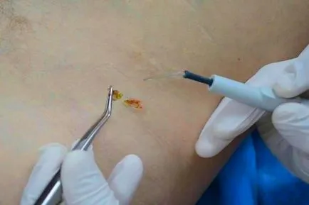 Papilloma, kezelése és okai, hogyan kell kezelni a HPV vírus emberekben (kezelés) Papilloma, kezelése és okai, hogyan kell kezelni a HPV vírus emberben