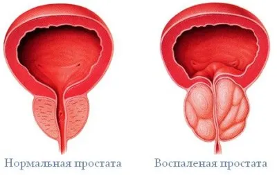 Az első jelei a prosztata, a kockázati tényezők, a tünetek, hogyan lehet felismerni a betegséget (faktorok) Az első jelei a prosztata, a kockázati tényezők, a tünetek, hogyan lehet felismerni a betegséget