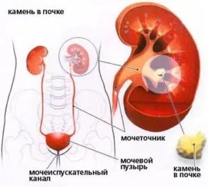Vesegörcs tünetek, kezelés, egészségügyi ábécé (kezelés) Vesegörcs tünetek, kezelés, egészségügyi ábécé