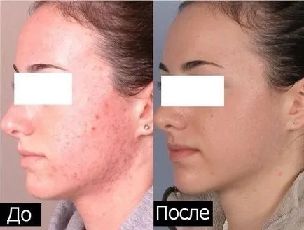Miért kapok pattanások az arcon, az igazság és az mítoszt akne (az igazság) Miért kapok pattanások az arcon, az igazság és az mítoszt akne