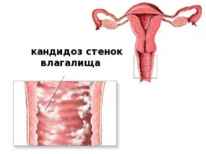 Miért víz kifolyik a vagina