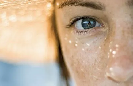 Miért jobb hyperpigmentation és hogyan lehet elkerülni, hogy