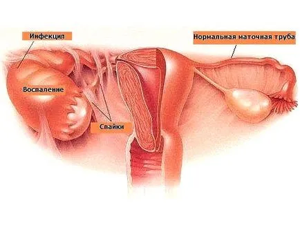 Miért víz kifolyik a vagina