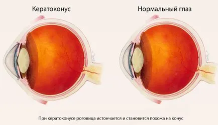 Az okok a rövidlátás (myopia) gyermekeknél és felnőtteknél (myopia) Az okok a rövidlátás (myopia) gyermekeknél és felnőtteknél