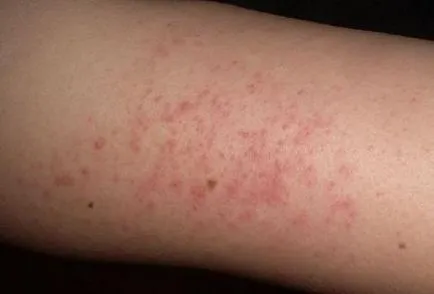 Pattanások lábak okokból és a szabadulásra (megjelenés) Pattanások lábak okokból és a szabadulásra