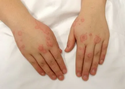Az okok az allergia - előfordulása a felnőtteknél, csalánkiütés, a nyak, a tenyér, a bőr az arcon