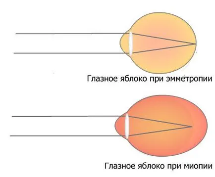 Az okok a rövidlátás (myopia) gyermekeknél és felnőtteknél (kelés) Az okok a rövidlátás (myopia) gyermekeknél és felnőtteknél