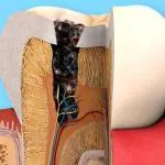 Megelőzés fogszuvasodás, hogyan lehet megelőzni a fogszuvasodás, eszközök és módszerek (caries) Megelőzés fogszuvasodás, hogyan lehet megelőzni a fogszuvasodás, eszközök és módszerek